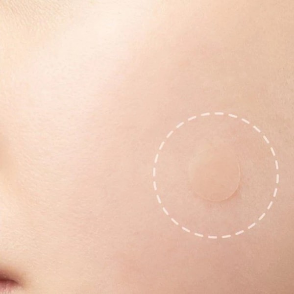 Before and after using mole remover patches