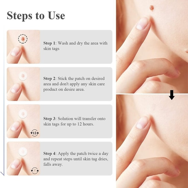 Easytouse skin tag remover patches