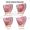 PELVIC ORGAN PROLAPSE VARIOUSLY [site].jpg