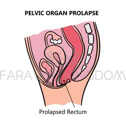 prolapsed rectum of women medical education scheme vector set