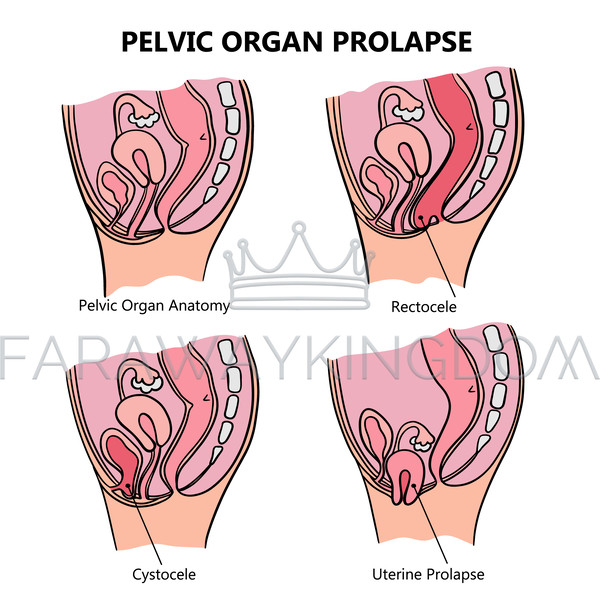 PELVIC ORGAN PROLAPSE VARIOUSLY [site].jpg