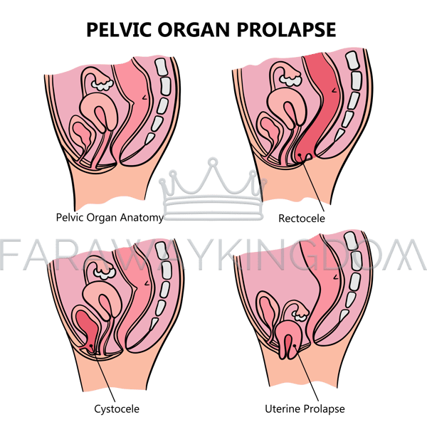 PELVIC ORGAN PROLAPSE VARIOUSLY [site].png