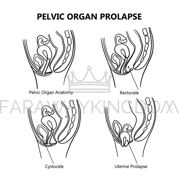 PELVIC ORGAN PROLAPSE VARIOUSLY MONOCHROME [site].jpg