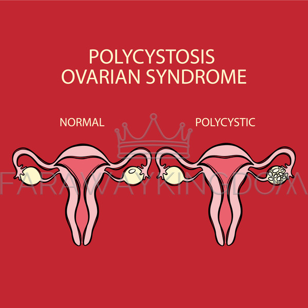 POLYCYSTIC OVARIAN SYNDROME VS NORMAL Reproductive System - Inspire Uplift