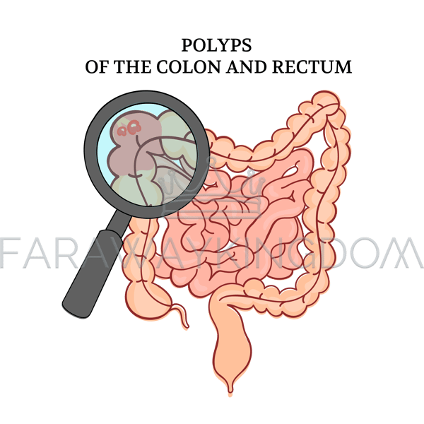 POLYPS OF THE COLON [site].png