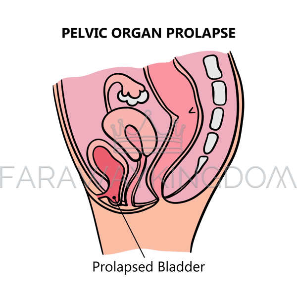 PROLAPSED BLADDER [site].png