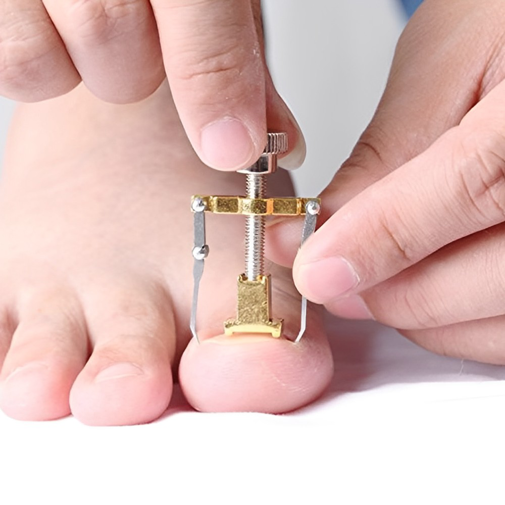 Ingrown Toenail Fixer Device