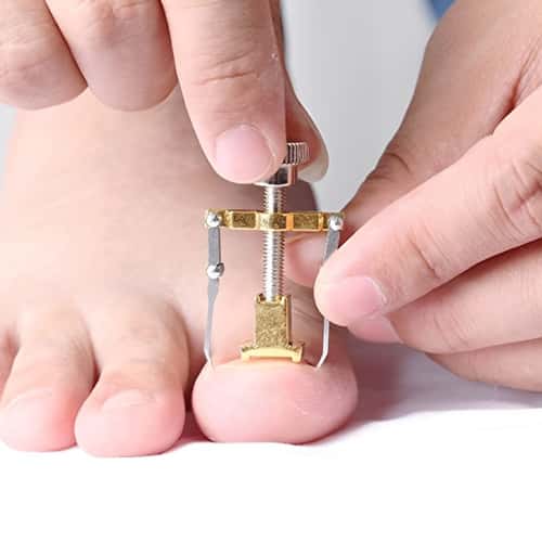 Ingrown Toenail Fixer Device – Ideal Gift for Healthy, Pain-Free Feet