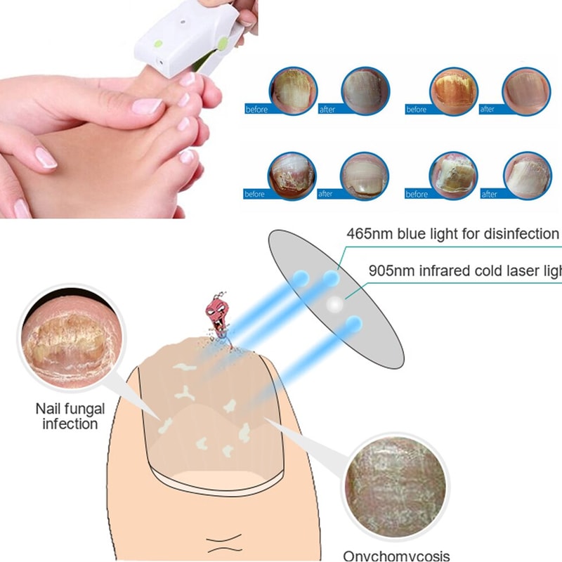 ledlightfornailfungustreatment5.png