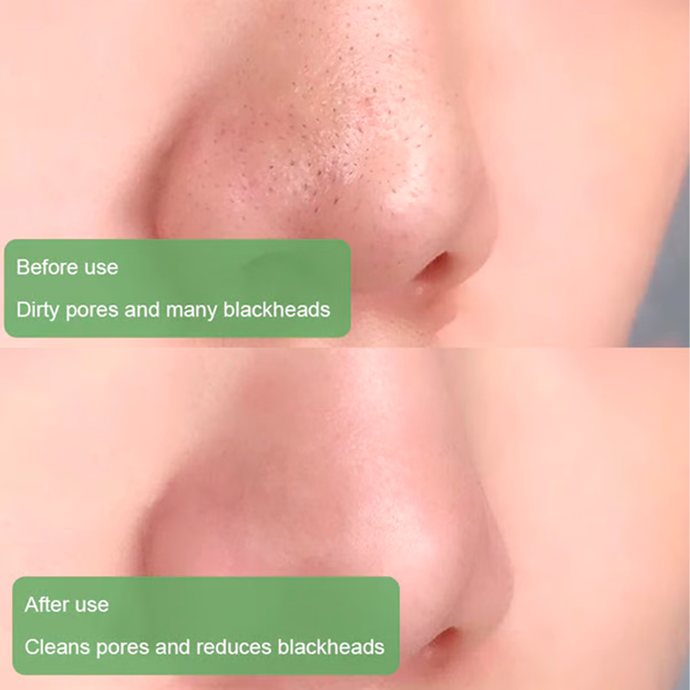 antiacneblackheadremovergreenteamask4.png